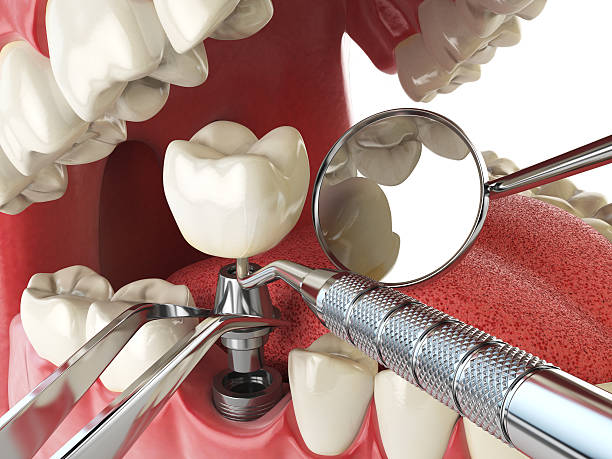 Best Emergency Wisdom Teeth Removal in Terrytown, LA